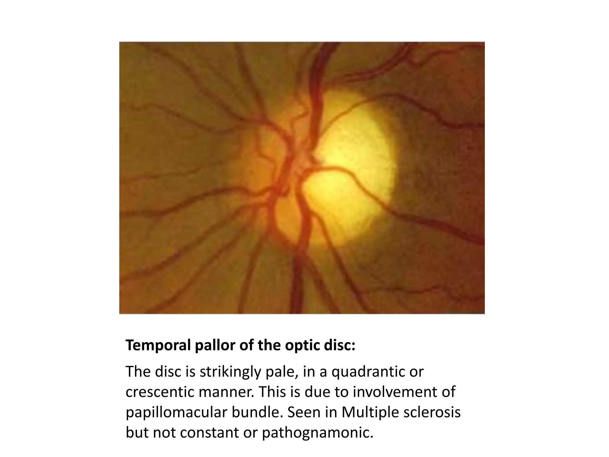 Temporal pallor of the optic disc:
The disc is strikingly pale, in a quadrantic or
crescentic manner. This is due to involvement of
papillomacular bundle. Seen in Multiple sclerosis
but not constant or pathognamonic.

 
