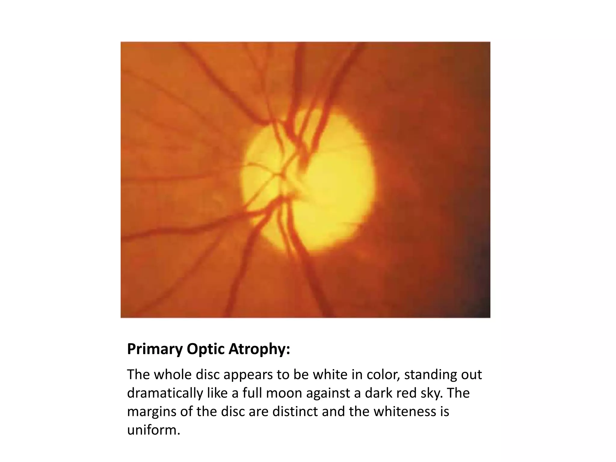 Primary Optic Atrophy:
The whole disc appears to be white in color, standing out
dramatically like a full moon against a dark red sky. The
margins of the disc are distinct and the whiteness is
uniform.

 
