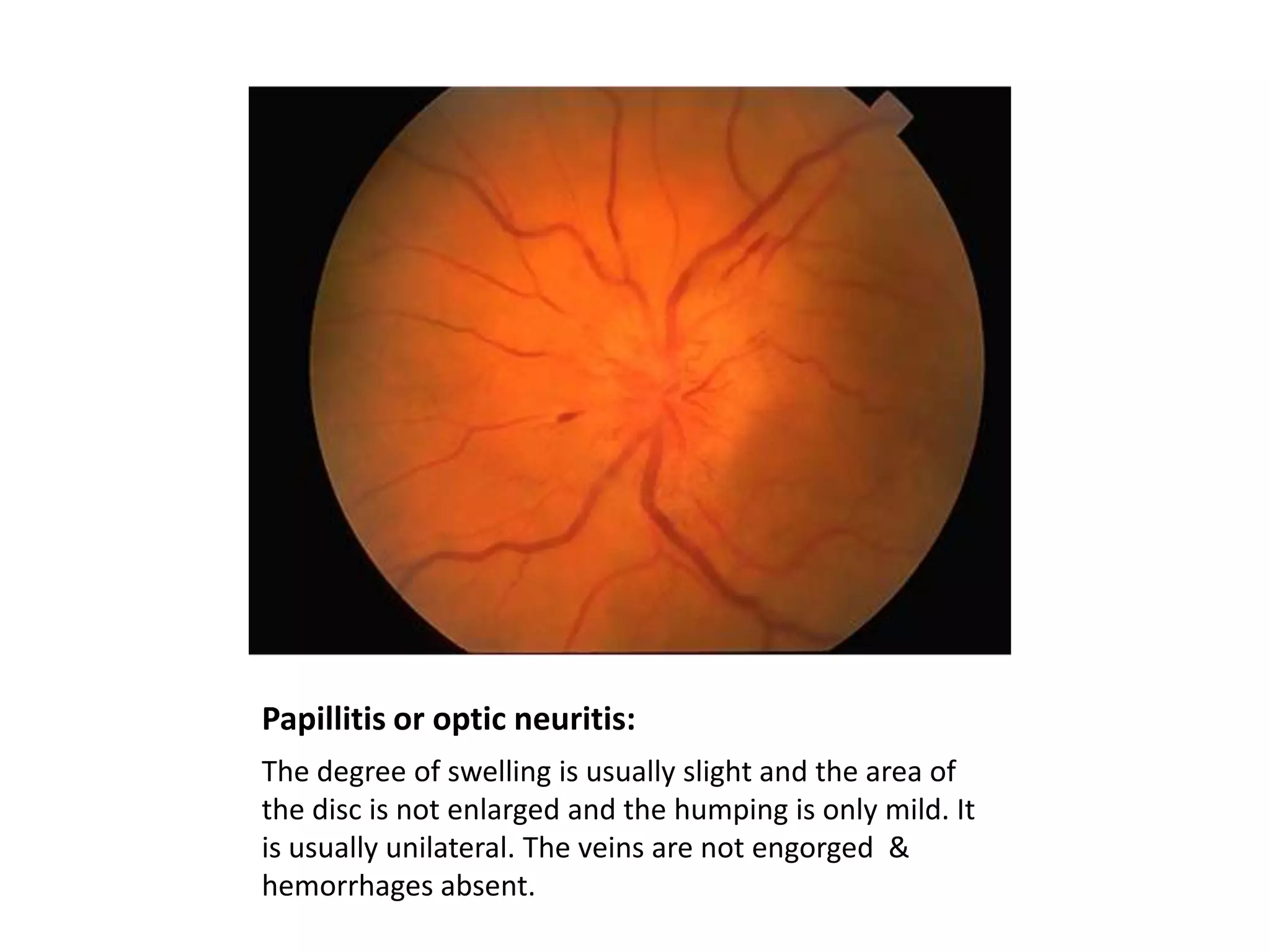 Papillitis or optic neuritis:
The degree of swelling is usually slight and the area of
the disc is not enlarged and the humping is only mild. It
is usually unilateral. The veins are not engorged &
hemorrhages absent.

 