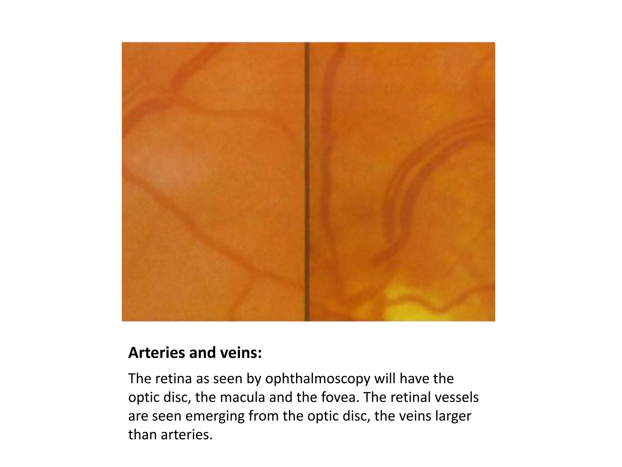 Arteries and veins:
The retina as seen by ophthalmoscopy will have the
optic disc, the macula and the fovea. The retinal vessels
are seen emerging from the optic disc, the veins larger
than arteries.

 