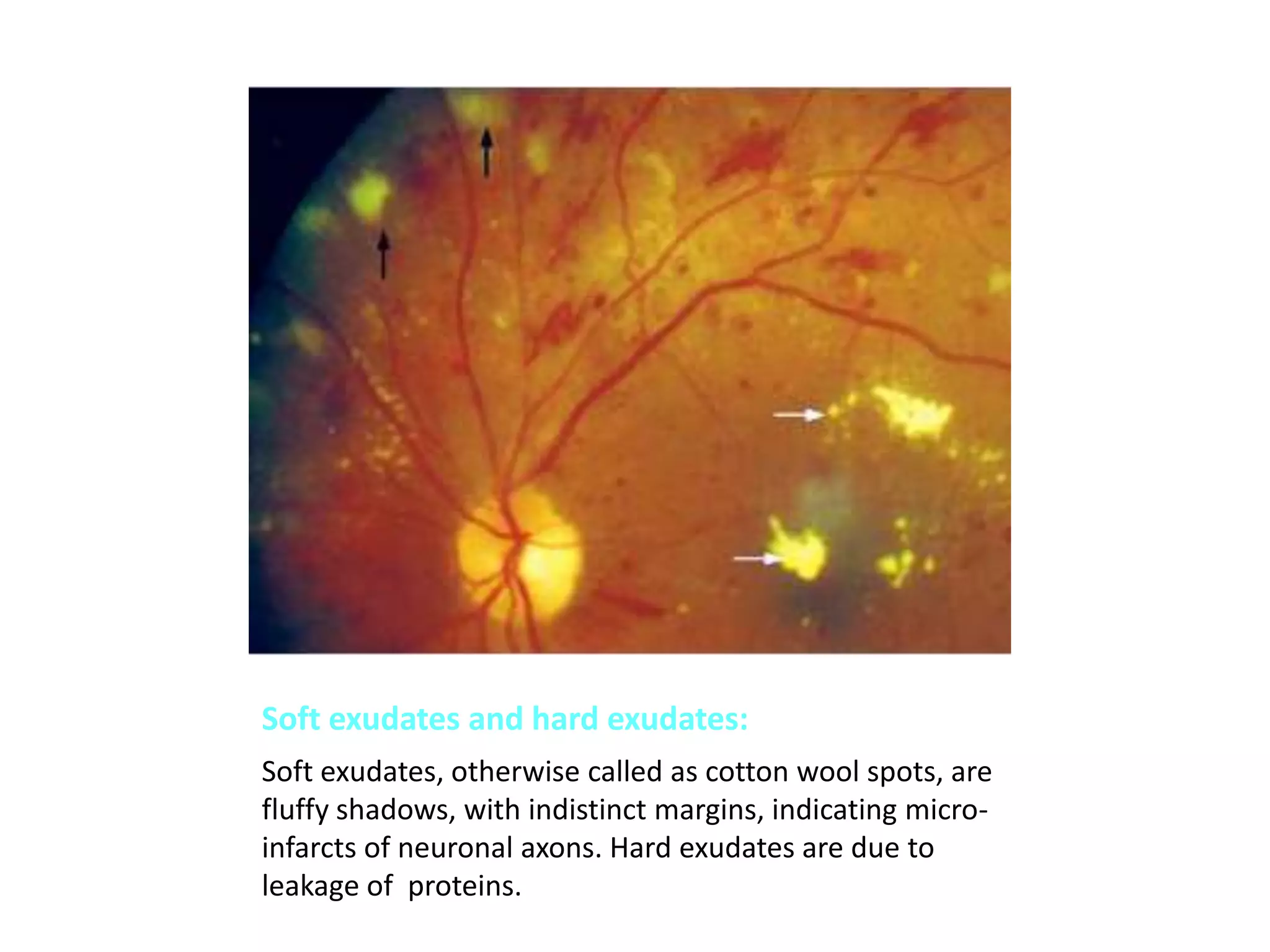 Soft exudates and hard exudates:
Soft exudates, otherwise called as cotton wool spots, are
fluffy shadows, with indistinct margins, indicating microinfarcts of neuronal axons. Hard exudates are due to
leakage of proteins.

 