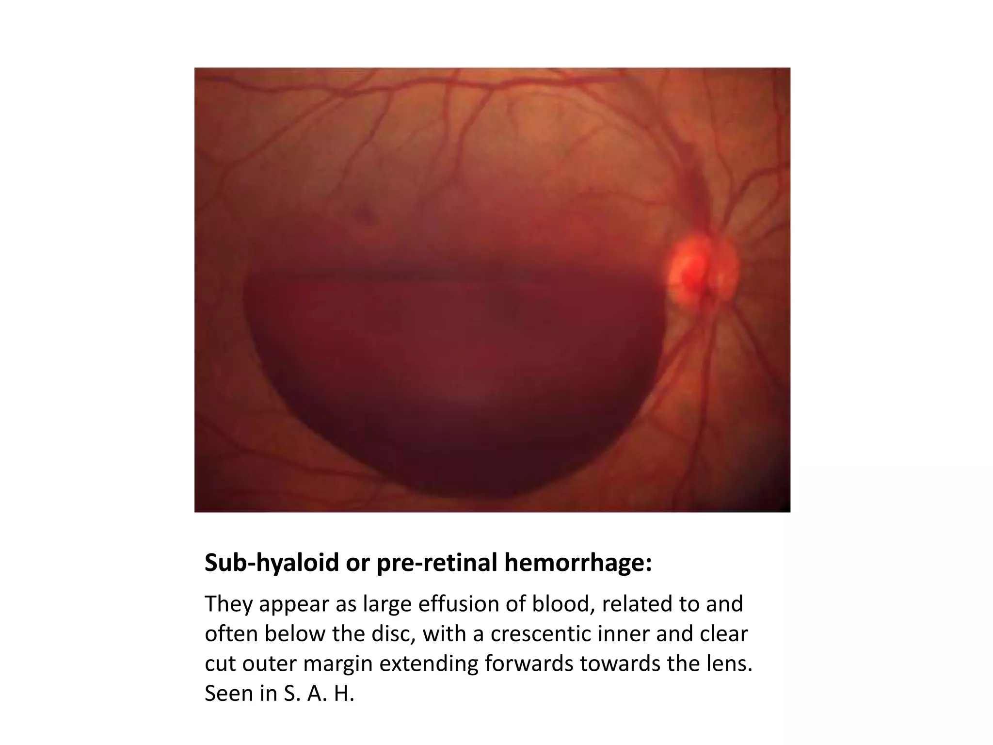 Sub-hyaloid or pre-retinal hemorrhage:
They appear as large effusion of blood, related to and
often below the disc, with a crescentic inner and clear
cut outer margin extending forwards towards the lens.
Seen in S. A. H.

 