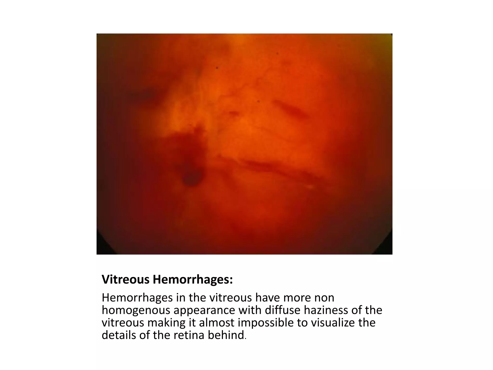 Vitreous Hemorrhages:
Hemorrhages in the vitreous have more non
homogenous appearance with diffuse haziness of the
vitreous making it almost impossible to visualize the
details of the retina behind.

 