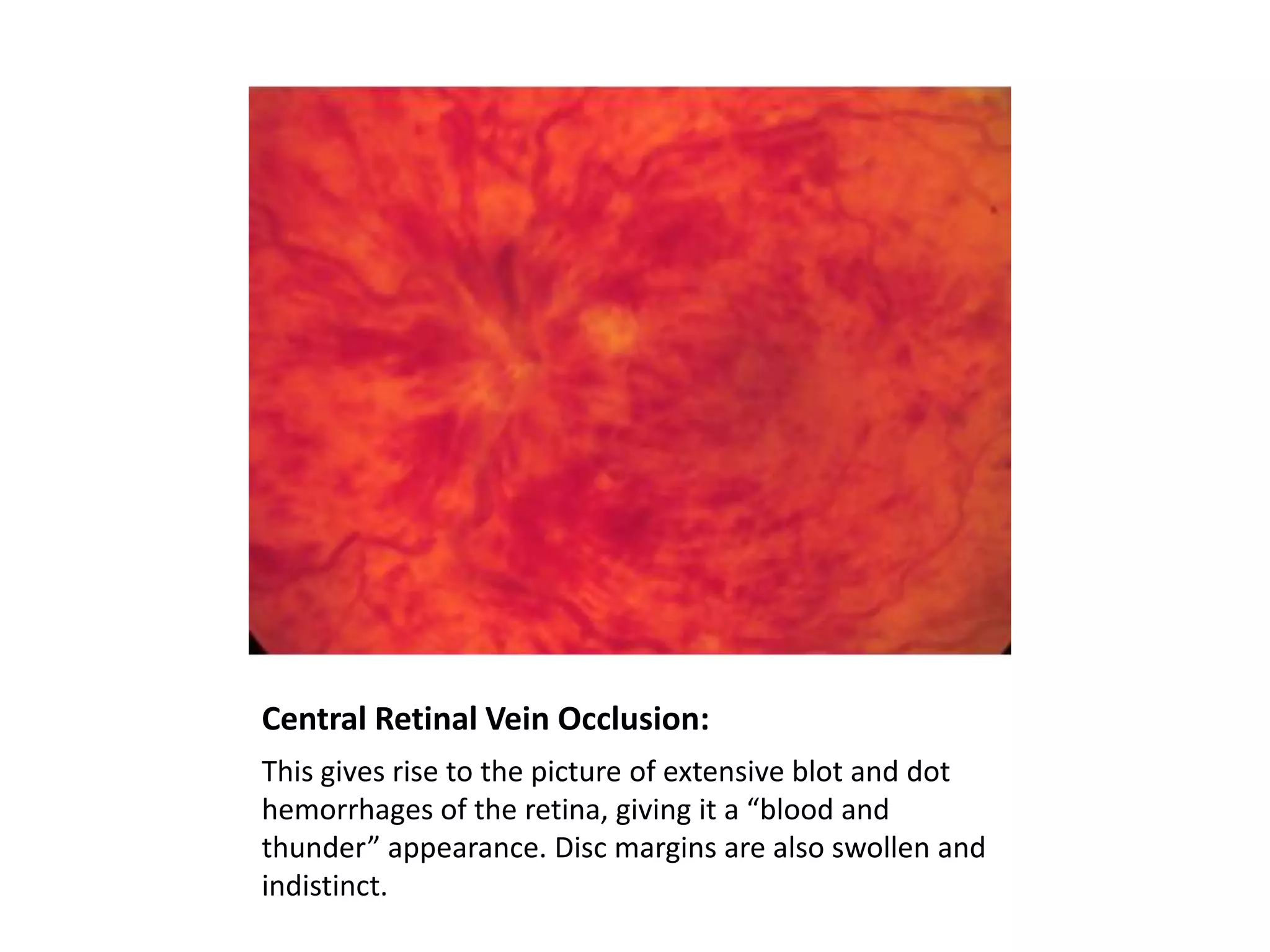 Central Retinal Vein Occlusion:
This gives rise to the picture of extensive blot and dot
hemorrhages of the retina, giving it a “blood and
thunder” appearance. Disc margins are also swollen and
indistinct.

 