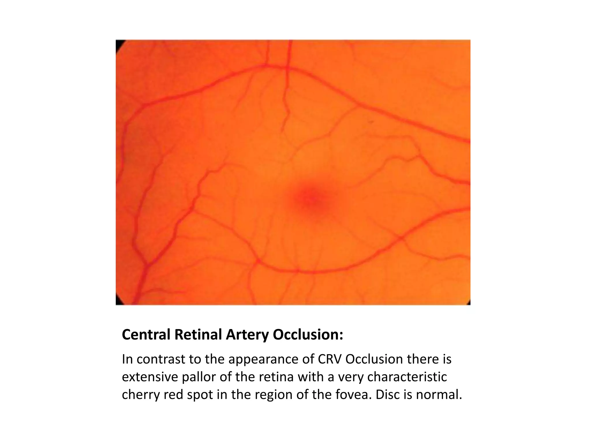 Central Retinal Artery Occlusion:
In contrast to the appearance of CRV Occlusion there is
extensive pallor of the retina with a very characteristic
cherry red spot in the region of the fovea. Disc is normal.

 