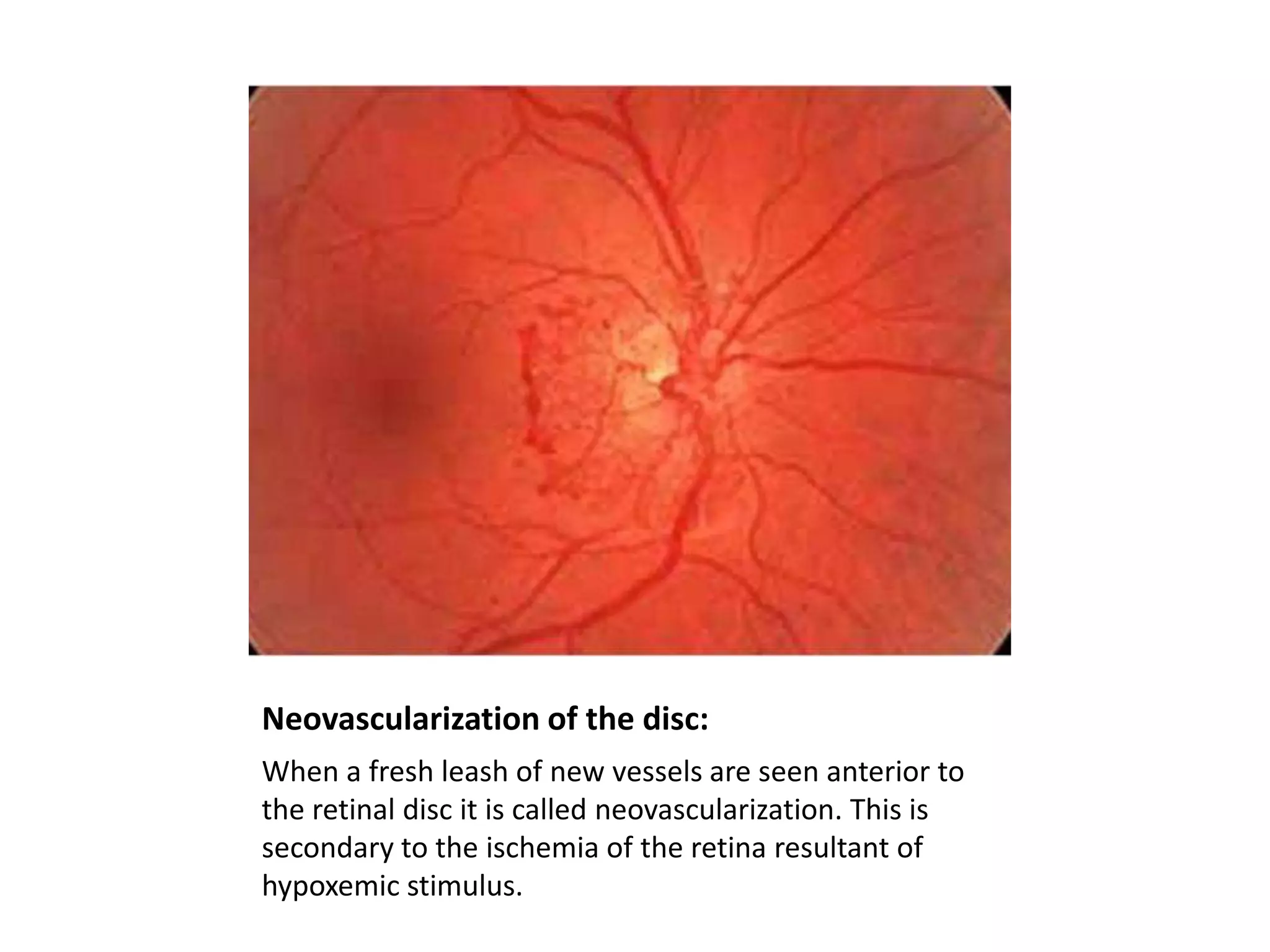 Neovascularization of the disc:
When a fresh leash of new vessels are seen anterior to
the retinal disc it is called neovascularization. This is
secondary to the ischemia of the retina resultant of
hypoxemic stimulus.

 