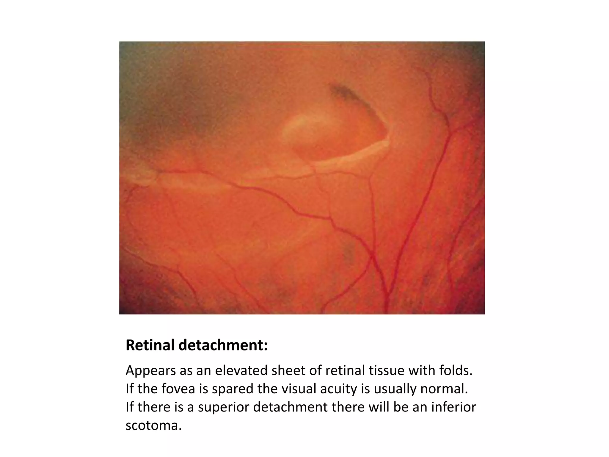Retinal detachment:
Appears as an elevated sheet of retinal tissue with folds.
If the fovea is spared the visual acuity is usually normal.
If there is a superior detachment there will be an inferior
scotoma.

 