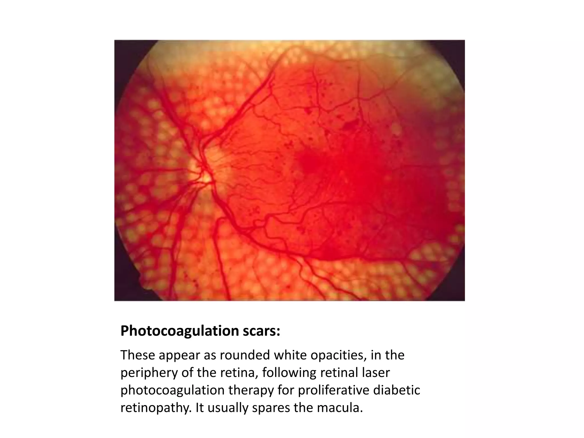 Photocoagulation scars:
These appear as rounded white opacities, in the
periphery of the retina, following retinal laser
photocoagulation therapy for proliferative diabetic
retinopathy. It usually spares the macula.

 