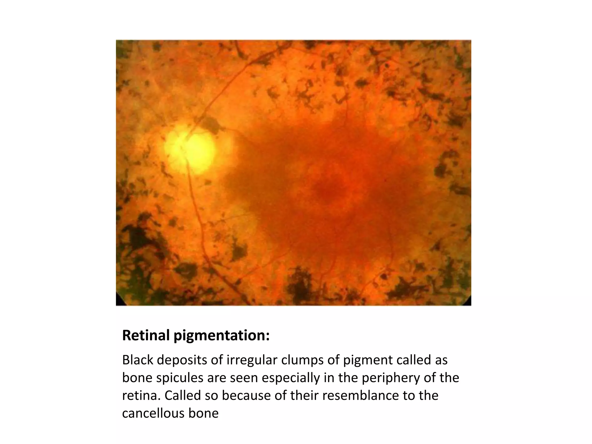 Retinal pigmentation:
Black deposits of irregular clumps of pigment called as
bone spicules are seen especially in the periphery of the
retina. Called so because of their resemblance to the
cancellous bone

 