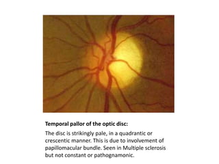 Temporal pallor of the optic disc:
The disc is strikingly pale, in a quadrantic or
crescentic manner. This is due to involvement of
papillomacular bundle. Seen in Multiple sclerosis
but not constant or pathognamonic.

 