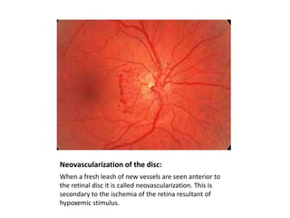 Neovascularization of the disc:
When a fresh leash of new vessels are seen anterior to
the retinal disc it is called neovascularization. This is
secondary to the ischemia of the retina resultant of
hypoxemic stimulus.

 
