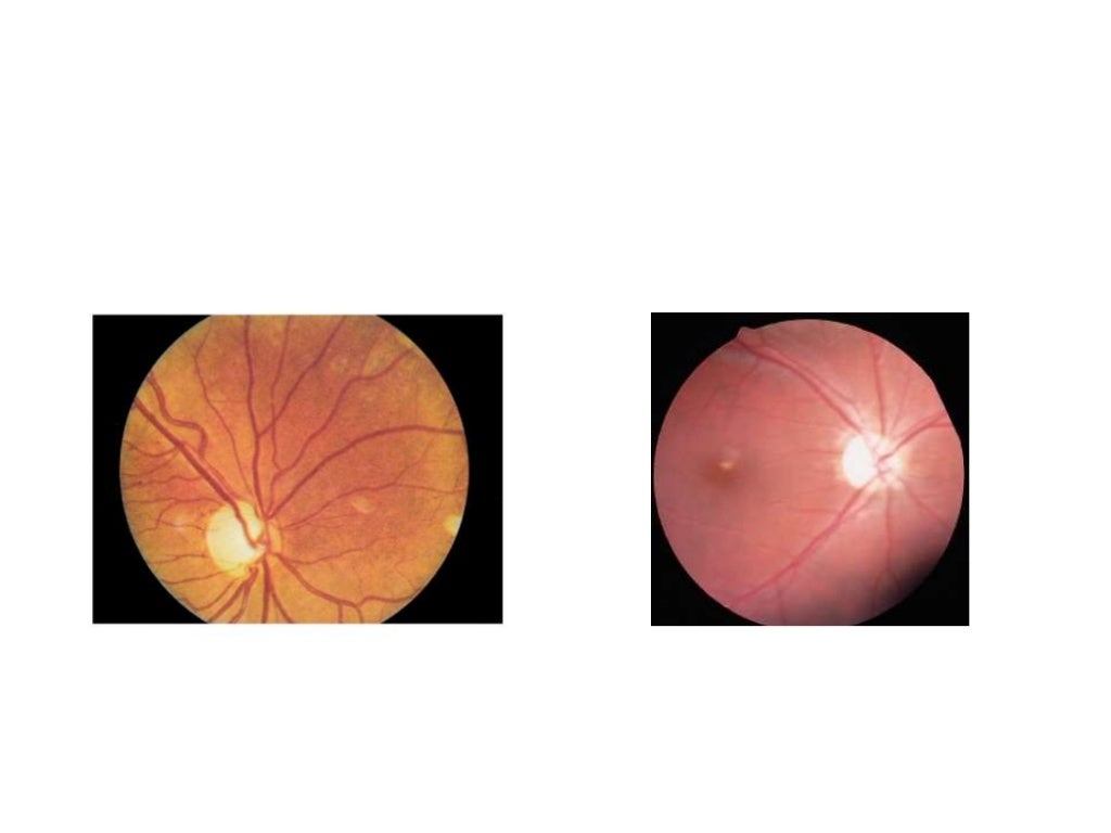 Direct Ophthalmoscopy
