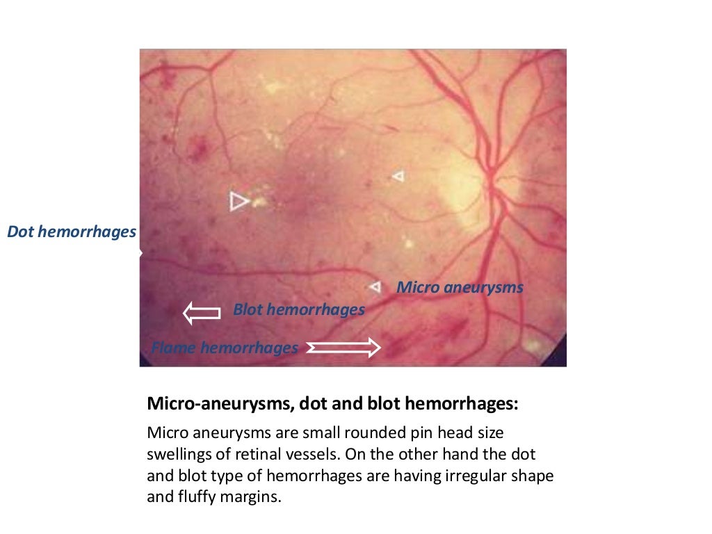 Direct Ophthalmoscopy