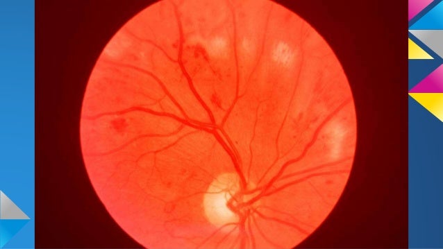 Fundoscopic Exam Osce