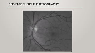 fundoscopy and papilledema ophthalmology [2].pptx