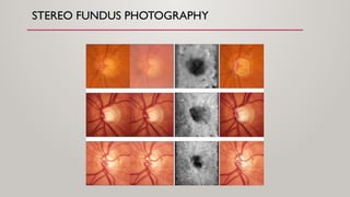 fundoscopy and papilledema ophthalmology [2].pptx