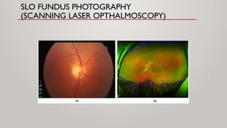 fundoscopy and papilledema ophthalmology [2].pptx