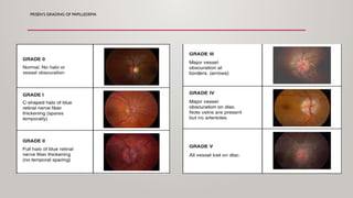 fundoscopy and papilledema ophthalmology [2].pptx