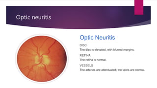 Optic neuritis
Optic Neuritis
DISC
The disc is elevated, with blurred margins.
RETINA
The retina is normal.
VESSELS
The arteries are attentuated; the veins are normal.
 