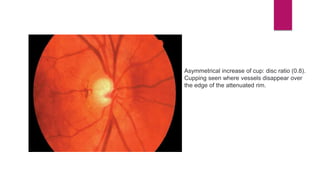 Asymmetrical increase of cup: disc ratio (0.8).
Cupping seen where vessels disappear over
the edge of the attenuated rim.
 