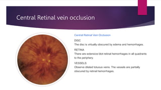 Central Retinal vein occlusion
Central Retinal Vein Occlusion
DISC
The disc is virtually obscured by edema and hemorrhages.
RETINA
There are extensive blot retinal hemorrhages in all quadrants
to the periphery.
VESSELS
Observe dilated totuous veins. The vessels are partially
obscured by retinal hemorrhages.
 