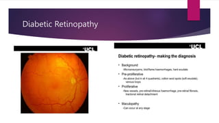 Diabetic Retinopathy
 