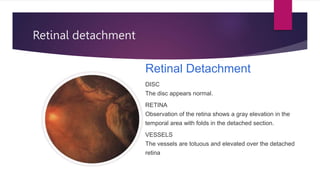 Retinal detachment
Retinal Detachment
DISC
The disc appears normal.
RETINA
Observation of the retina shows a gray elevation in the
temporal area with folds in the detached section.
VESSELS
The vessels are totuous and elevated over the detached
retina
 
