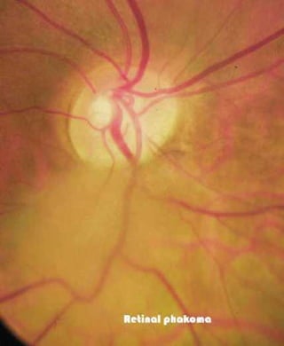 Fundus examination