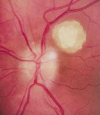 Fundus examination