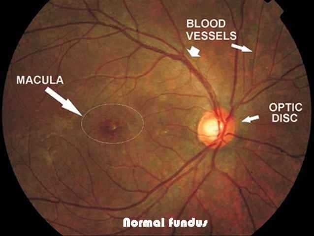 fundus exam findings fundus examination fundus exam findings fundus examination