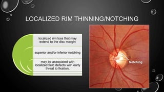 Notching Helical Rim Funduscopy evaluation in glaucomatous optic | PPTX