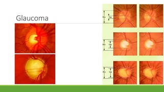 Glaucoma
 