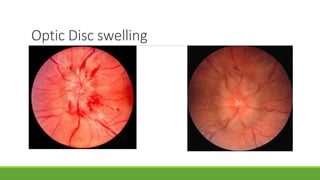 Optic Disc swelling
 