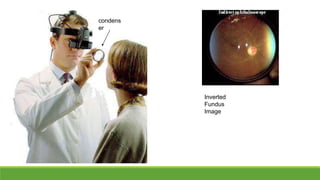 Advantages:
◦ Wide field of view
◦ Binocular instruments provide
stereopsis
Disadvantages:
◦ Requires more skill
◦ Decreas...