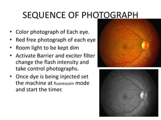 SEQUENCE OF PHOTOGRAPH
• Color photograph of Each eye.
• Red free photograph of each eye
• Room light to be kept dim
• Activate Barrier and exciter filter
change the flash intensity and
take control photographs.
• Once dye is being injected set
the machine at fluorescein mode
and start the timer.
 