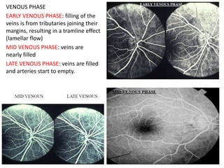 VENOUS PHASE
EARLY VENOUS PHASE: filling of the
veins is from tributaries joining their
margins, resulting in a tramline effect
(lamellar flow)
MID VENOUS PHASE: veins are
nearly filled
LATE VENOUS PHASE: veins are filled
and arteries start to empty.
 