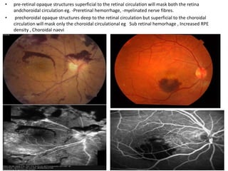 • pre-retinal opaque structures superficial to the retinal circulation will mask both the retina
andchoroidal circulation eg. -Preretinal hemorrhage, -myelinated nerve fibres.
• prechoroidal opaque structures deep to the retinal circulation but superficial to the choroidal
circulation will mask only the choroidal circulational eg Sub retinal hemorhage , Increased RPE
density , Choroidal naevi
 
