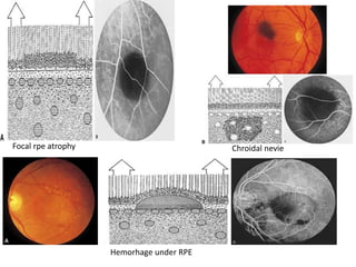 Focal rpe atrophy Chroidal nevie
Hemorhage under RPE
 