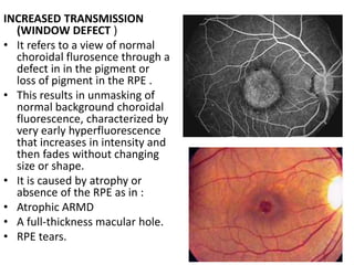 INCREASED TRANSMISSION
(WINDOW DEFECT )
• It refers to a view of normal
choroidal flurosence through a
defect in in the pigment or
loss of pigment in the RPE .
• This results in unmasking of
normal background choroidal
fluorescence, characterized by
very early hyperfluorescence
that increases in intensity and
then fades without changing
size or shape.
• It is caused by atrophy or
absence of the RPE as in :
• Atrophic ARMD
• A full-thickness macular hole.
• RPE tears.
 