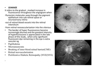 • LEAKAGE
It refers to the gradual , marked increase in
fluorescence throughout the angiogram when
-fluroscien molecules seep through the pigment
epithelium into sub reitnal space or
neurosensory retina
-out of retinal blood vessels into the retinal
intersitium
-from retinal neovascularization into the viterous
• The border of hyper fluorescence become
increasingly blurred and the greatest intensity
of hyperfluroscene is appreciated in the late
phase of the study , when only significant
fluorescein dye remaining in the eye is extra
vascular eg
• Papilledema
• Microaneurysms
• Breaking of inner blood retinal barrier(CME)
• Retinal neovascularization
• Proliferative Diabetic Retinopathy (NVD,NVE)
-
 