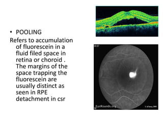 • POOLING
Refers to accumulation
of fluorescein in a
fluid filed space in
retina or choroid .
The margins of the
space trapping the
fluorescein are
usually distinct as
seen in RPE
detachment in csr
 