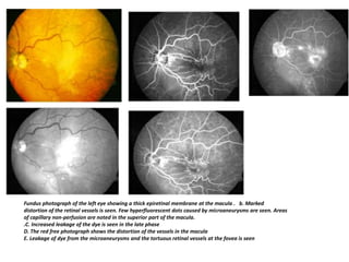 Fundus photograph of the left eye showing a thick epiretinal membrane at the macula . b. Marked
distortion of the retinal vessels is seen. Few hyperfluorescent dots caused by microaneurysms are seen. Areas
of capillary non-perfusion are noted in the superior part of the macula.
.C. Increased leakage of the dye is seen in the late phase
D. The red free photograph shows the distortion of the vessels in the macula
E. Leakage of dye from the microaneurysms and the tortuous retinal vessels at the fovea is seen
 
