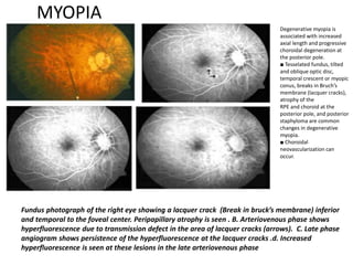 MYOPIA
Fundus photograph of the right eye showing a lacquer crack (Break in bruck’s membrane) inferior
and temporal to the foveal center. Peripapillary atrophy is seen . B. Arteriovenous phase shows
hyperfluorescence due to transmission defect in the area of lacquer cracks (arrows). C. Late phase
angiogram shows persistence of the hyperfluorescence at the lacquer cracks .d. Increased
hyperfluorescence is seen at these lesions in the late arteriovenous phase
Degenerative myopia is
associated with increased
axial length and progressive
choroidal degeneration at
the posterior pole.
■ Tesselated fundus, tilted
and oblique optic disc,
temporal crescent or myopic
conus, breaks in Bruch’s
membrane (lacquer cracks),
atrophy of the
RPE and choroid at the
posterior pole, and posterior
staphyloma are common
changes in degenerative
myopia.
■ Choroidal
neovascularization can
occur.
 