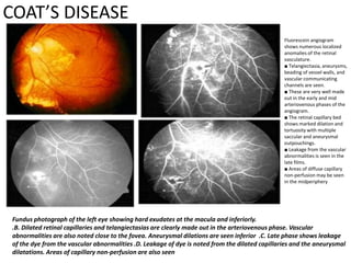 COAT’S DISEASE
Fundus photograph of the left eye showing hard exudates at the macula and inferiorly.
.B. Dilated retinal capillaries and telangiectasias are clearly made out in the arteriovenous phase. Vascular
abnormalities are also noted close to the fovea. Aneurysmal dilations are seen inferior .C. Late phase shows leakage
of the dye from the vascular abnormalities .D. Leakage of dye is noted from the dilated capillaries and the aneurysmal
dilatations. Areas of capillary non-perfusion are also seen
Fluorescein angiogram
shows numerous localized
anomalies of the retinal
vasculature.
■ Telangiectasia, aneurysms,
beading of vessel walls, and
vascular communicating
channels are seen.
■ These are very well made
out in the early and mid
arteriovenous phases of the
angiogram.
■ The retinal capillary bed
shows marked dilation and
tortuosity with multiple
saccular and aneurysmal
outpouchings.
■ Leakage from the vascular
abnormalities is seen in the
late films.
■ Areas of diffuse capillary
non-perfusion may be seen
in the midperiphery
 
