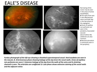 EALE’S DISEASE
Fundus photograph of the left eye showing a sheathed superotemporal vessel. Hard exudates are seen in
the macula .B. Arteriovenous phase showing leakage of the dye from the vessel walls. Areas of capillary
non-perfusion are seen.C. Extensive leakage of the dye from the walls of the veins and its draining
channels is seen. The arterioles are unaffected .D. Late phase shows extensive staining of the vessel walls
and the adjacent retina
Narrowing of the
lumen may be seen
in the areas of active
periphlebitis.
■ The wall of the vein
in the affected part
stains and leaks dye
in the late phase of
the angiogram.
■ Areas of capillary
non-perfusion are
seen in the
periphery. Associated
vascular
abnormalities like
collaterals are also
common.
■ Neovascularization
is commonly seen in
the periphery.
 