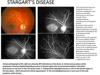 STARGART’S DISEASE
The characteristic feature of
Stargardt’s disease on a
fluorescein angiogram is the
absence of choroidal
fluorescence or the ‘silent
choroid’. This is
considered almost
pathognomonic of Stargardt’s
disease.
■ Lipofuscin like material
deposition in the retinal
pigment epithelium is probably
responsible for blockage of the
underlying choroidal
fluorescence.
■ The retinal vessels especially
the retinal capillary network
are seen more prominently
against the dark background.
■ The atrophic macular lesion
shows up as a hyperfluorescent
area due to window defect.
■ Multiple irregular
hyperfluorescent spots that do
not precisely correspond to the
flecks are seen in the
midperipheral retina
Fundus photograph of the right eye showing RPE alterations at the fovea .B. Arteriovenous phase of the
angiogram showing stippled hyperfluorescence in foveal region due to transmission defects. Choroidal
fluorescence is not seen in the rest of the areas .C. Fading of the hyperfluorescence is seen in the foveal region in
the late phase . Silent choroid can still be appreciated .D. No choroidalfluorescence is seen even in the mid-
periphery of the fundus
 