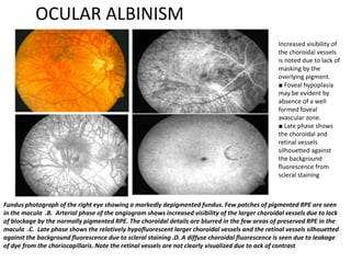 OCULAR ALBINISM
Increased visibility of
the choroidal vessels
is noted due to lack of
masking by the
overlying pigment.
■ Foveal hypoplasia
may be evident by
absence of a well
formed foveal
avascular zone.
■ Late phase shows
the choroidal and
retinal vessels
silhouetted against
the background
fluorescence from
scleral staining
Fundus photograph of the right eye showing a markedly depigmented fundus. Few patches of pigmented RPE are seen
in the macula .B. Arterial phase of the angiogram shows increased visibility of the larger choroidal vessels due to lack
of blockage by the normally pigmented RPE. The choroidal details are blurred in the few areas of preserved RPE in the
macula .C. Late phase shows the relatively hypofluorescent larger choroidal vessels and the retinal vessels silhouetted
against the background fluorescence due to scleral staining .D. A diffuse choroidal fluorescence is seen due to leakage
of dye from the choriocapillaris. Note the retinal vessels are not clearly visualized due to ack of contrast
 