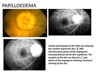 PAPILLOEDEMA
Fundus photograph of the right eye showing
the swollen hyperemic disc .B. Mid
arteriovenous phase of the angiogram
showing dilation of the disc capillaries. The
margins of the disc are blurred .C. Late
phase of the angiogram showing increased
staining of the disc
 