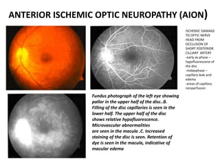 ANTERIOR ISCHEMIC OPTIC NEUROPATHY (AION)
Fundus photograph of the left eye showing
pallor in the upper half of the disc..B.
Filling of the disc capillaries is seen in the
lower half. The upper half of the disc
shows relative hypofluorescence.
Microvascular abnormalities
are seen in the macula .C. Increased
staining of the disc is seen. Retention of
dye is seen in the macula, indicative of
macular edema
ISCHEMIC DAMAGE
TO OPTIC NERVE
HEAD FROM
OCCLUSION OF
SHORT POSTERIOR
CILLIARY ARTERY
-early av phase –
hypofluorescene of
the disc
-midavphase –
capillary leak and
edema
-areas of capillary
nonperfusion
 