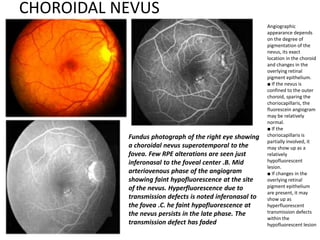 CHOROIDAL NEVUS
Fundus photograph of the right eye showing
a choroidal nevus superotemporal to the
fovea. Few RPE alterations are seen just
inferonasal to the foveal center .B. Mid
arteriovenous phase of the angiogram
showing faint hypofluorescence at the site
of the nevus. Hyperfluorescence due to
transmission defects is noted inferonasal to
the fovea .C. he faint hypofluorescence at
the nevus persists in the late phase. The
transmission defect has faded
Angiographic
appearance depends
on the degree of
pigmentation of the
nevus, its exact
location in the choroid
and changes in the
overlying retinal
pigment epithelium.
■ If the nevus is
confined to the outer
choroid, sparing the
choriocapillaris, the
fluorescein angiogram
may be relatively
normal.
■ If the
choriocapillaris is
partially involved, it
may show up as a
relatively
hypofluorescent
lesion.
■ If changes in the
overlying retinal
pigment epithelium
are present, it may
show up as
hyperfluorescent
transmission defects
within the
hypofluorescent lesion
 